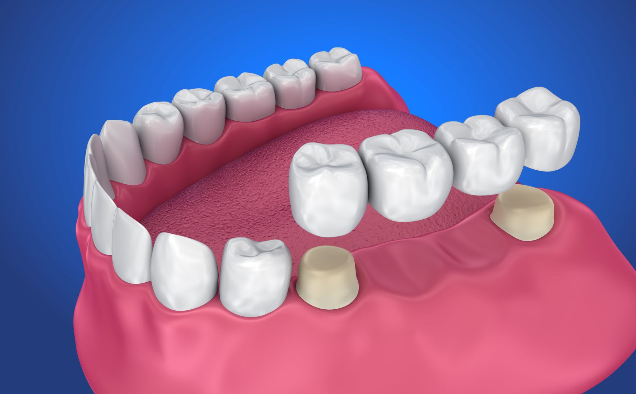 Dental Crown and Bridge